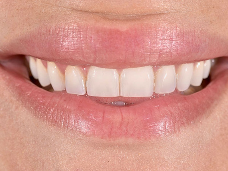 Smile Makeover Closeups Before & After Gallery - Patient 186106850 - Image 1