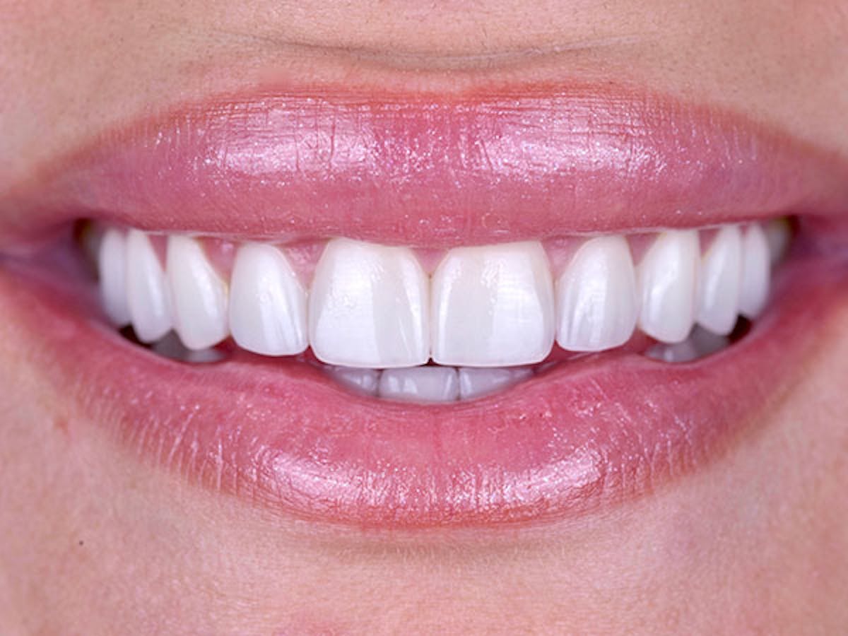 Smile Makeover Closeups Before & After Gallery - Patient 186106850 - Image 2