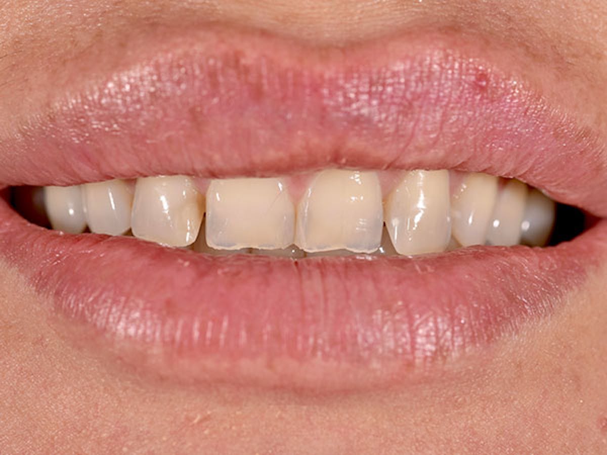Smile Makeover Closeups Before & After Gallery - Patient 186113364 - Image 1