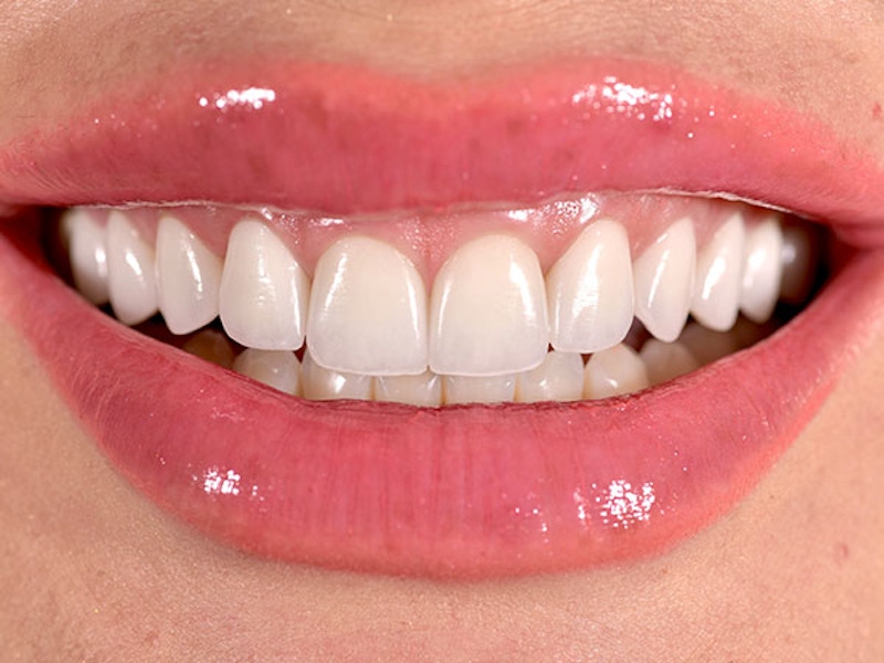 Smile Makeover Closeups Before & After Gallery - Patient 186113364 - Image 2