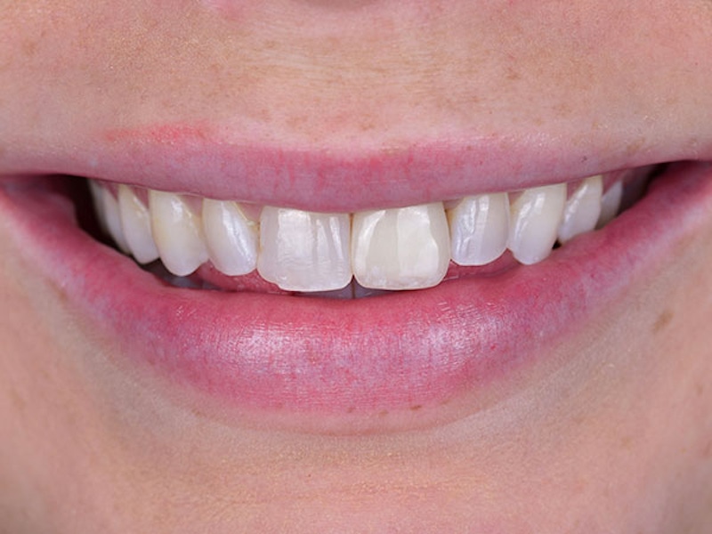 Smile Makeover Closeups Before & After Gallery - Patient 186113365 - Image 1