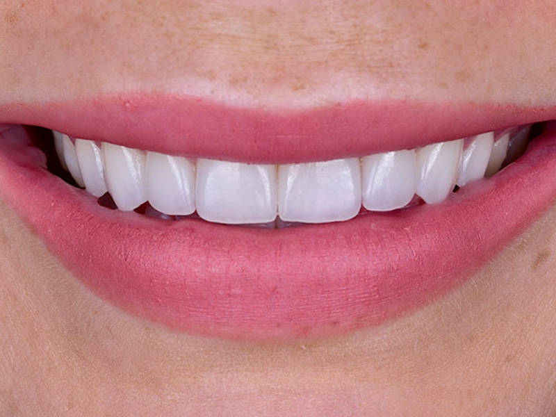 Smile Makeover Closeups Before & After Gallery - Patient 186113365 - Image 2