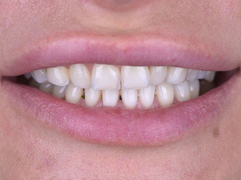 Smile Makeover Closeups Before & After Gallery - Patient 186113366 - Image 1
