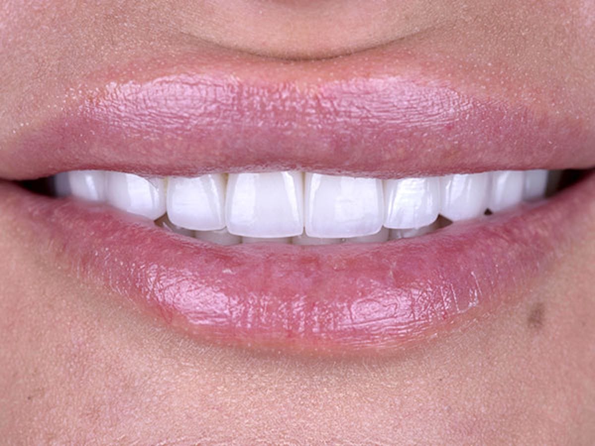 Smile Makeover Closeups Before & After Gallery - Patient 186113366 - Image 2