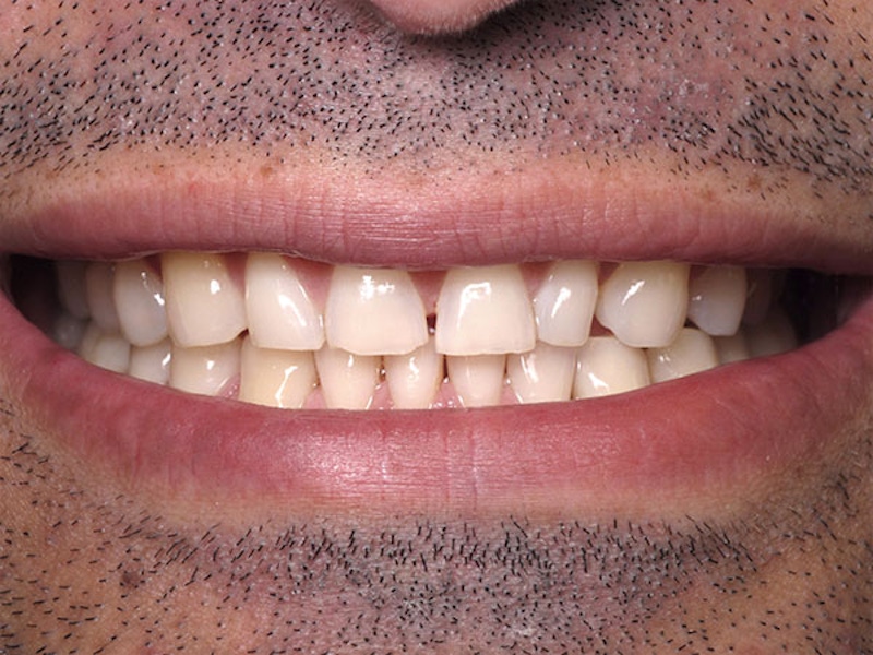 Smile Makeover Closeups Before & After Gallery - Patient 186113367 - Image 1