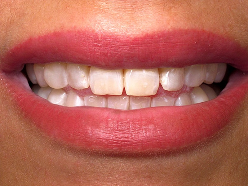 Smile Makeover Closeups Before & After Gallery - Patient 186113368 - Image 1