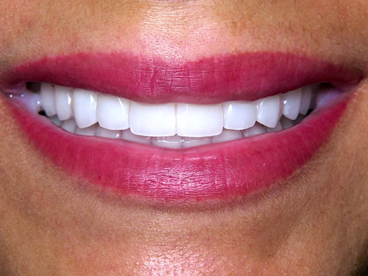 Smile Makeover Closeups Before & After Gallery - Patient 186113368 - Image 2