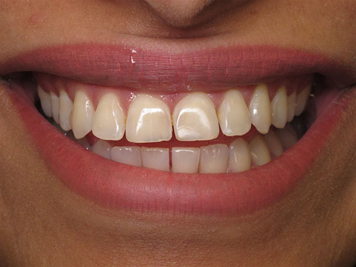 Smile Makeover Closeups Before & After Gallery - Patient 186113369 - Image 1