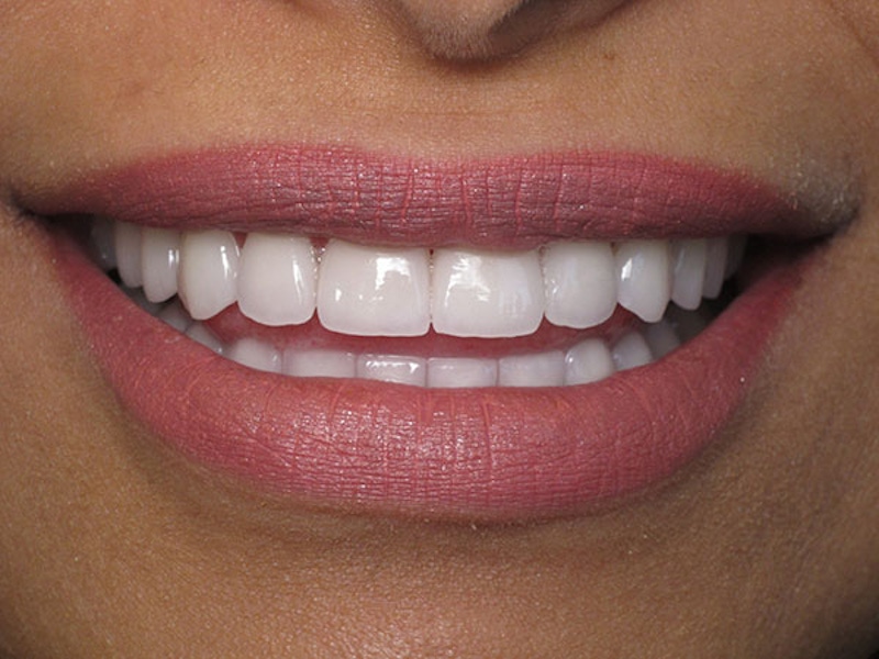 Smile Makeover Closeups Before & After Gallery - Patient 186113369 - Image 2