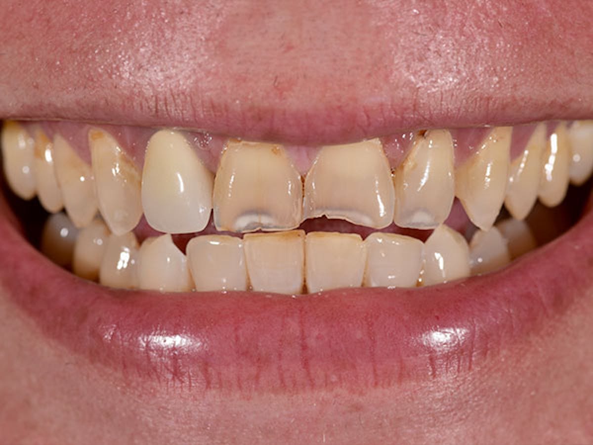 Smile Makeover Closeups Before & After Gallery - Patient 186113370 - Image 1