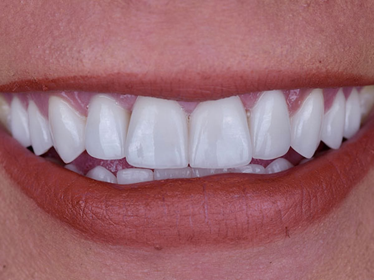 Smile Makeover Closeups Before & After Gallery - Patient 186113370 - Image 2