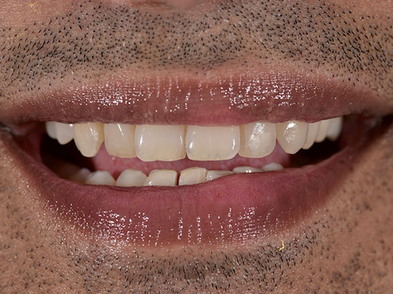 Smile Makeover Closeups Before & After Gallery - Patient 186113373 - Image 1