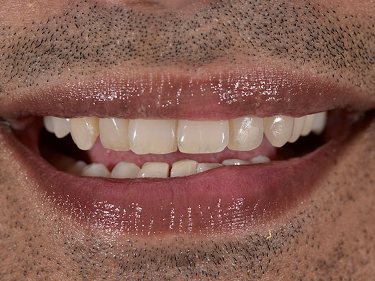 Smile Makeover Closeups Before & After Gallery - Patient 186113373 - Image 1