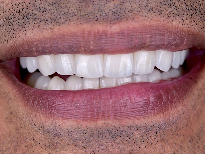 Smile Makeover Closeups Before & After Gallery - Patient 186113373 - Image 2
