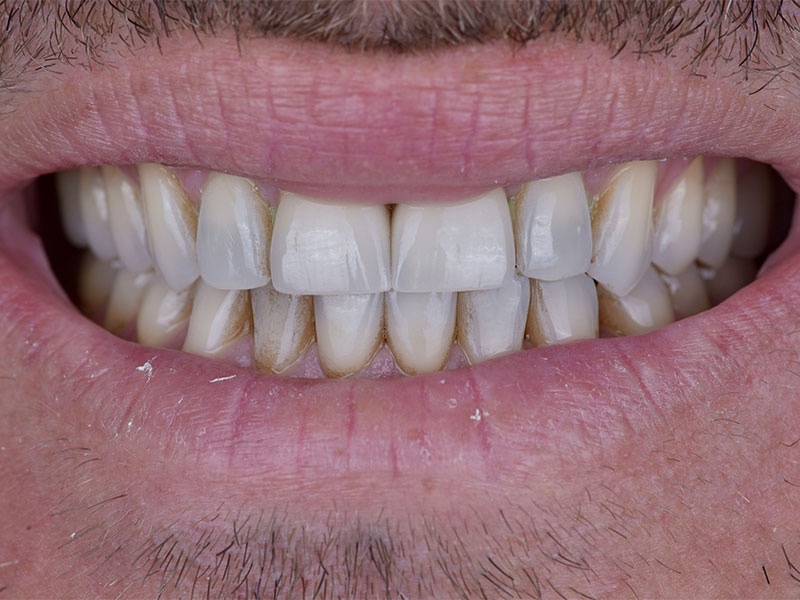 Smile Makeover Closeups Before & After Gallery - Patient 192281093 - Image 1