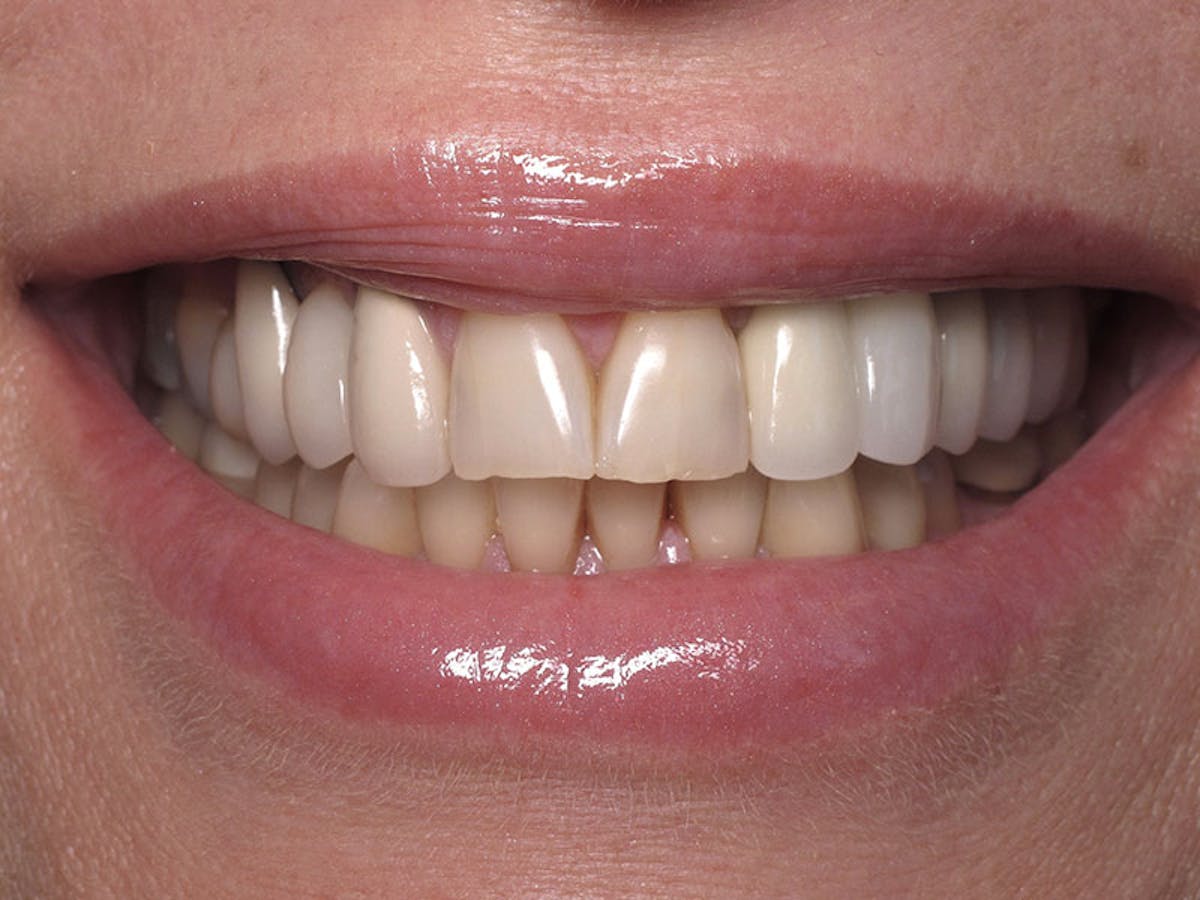 Smile Makeover Closeups Before & After Gallery - Patient 192281090 - Image 1