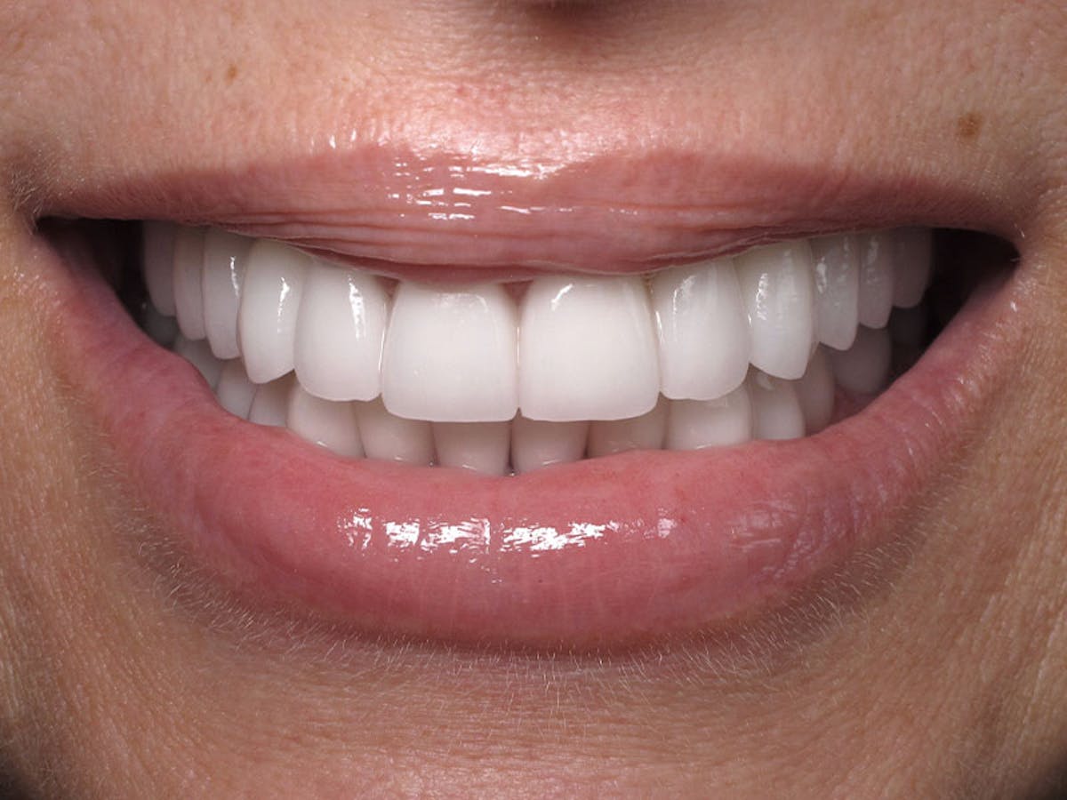 Smile Makeover Closeups Before & After Gallery - Patient 192281090 - Image 2