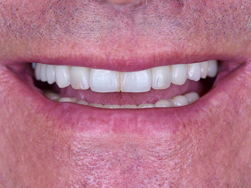 Smile Makeover Closeups Before & After Gallery - Patient 192281092 - Image 1
