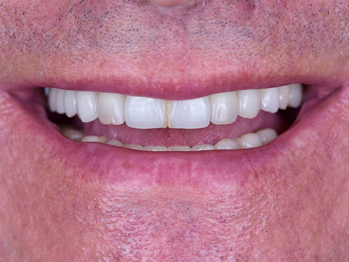 Smile Makeover Closeups Before & After Gallery - Patient 192281092 - Image 1