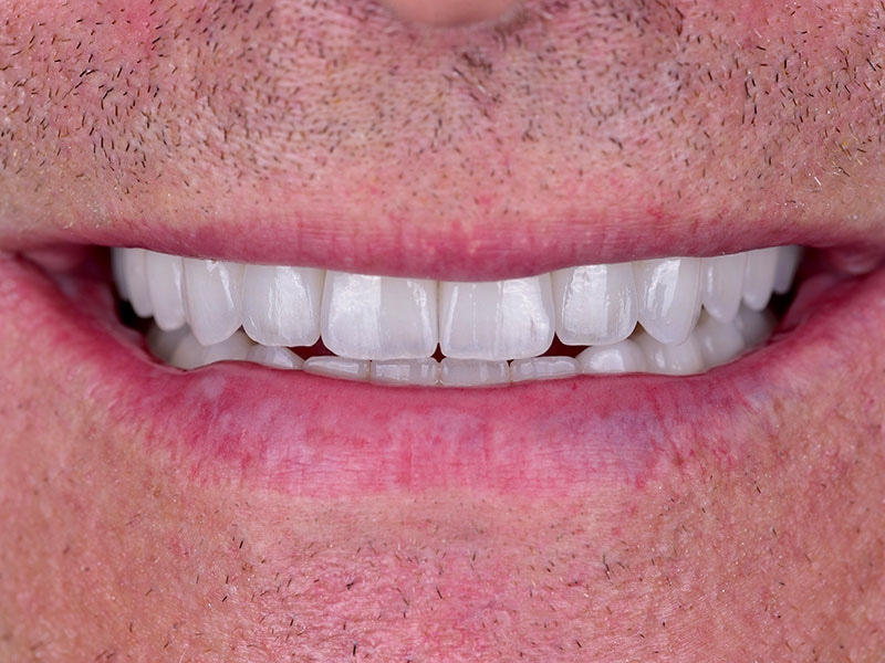 Smile Makeover Closeups Before & After Gallery - Patient 192281092 - Image 2