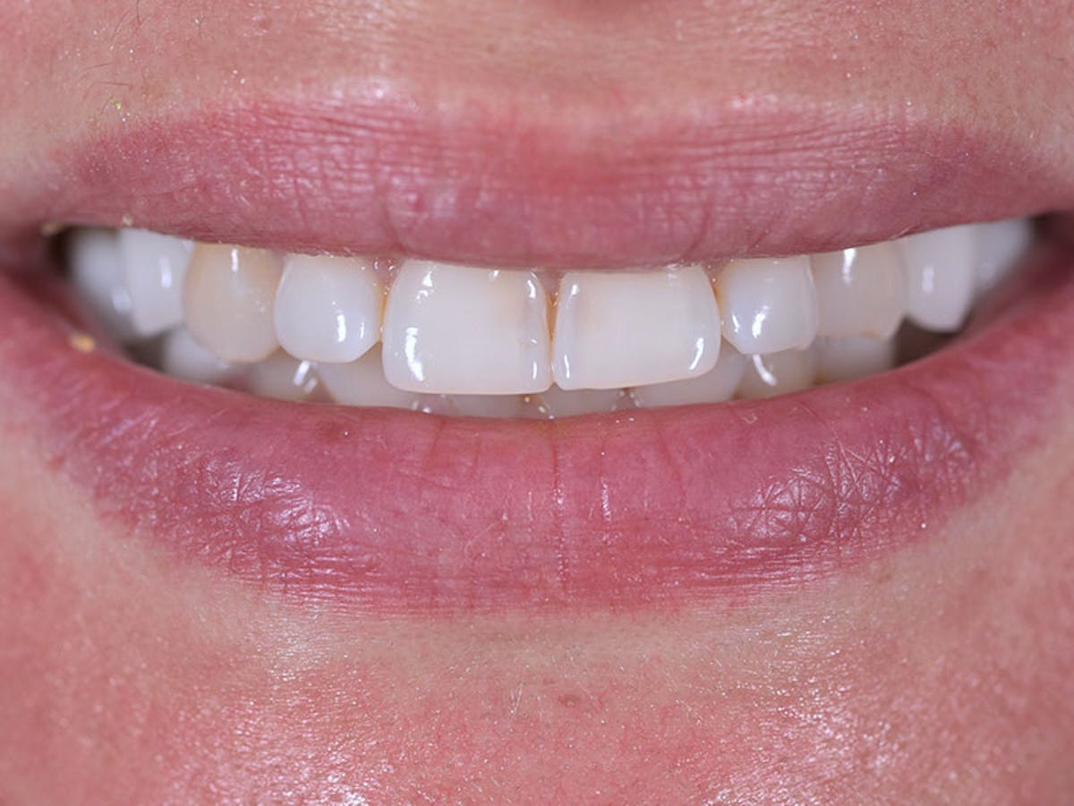Smile Makeover Closeups Before & After Gallery - Patient 192281088 - Image 1