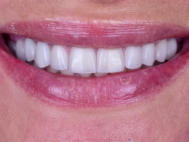 Smile Makeover Closeups Before & After Gallery - Patient 192281088 - Image 2