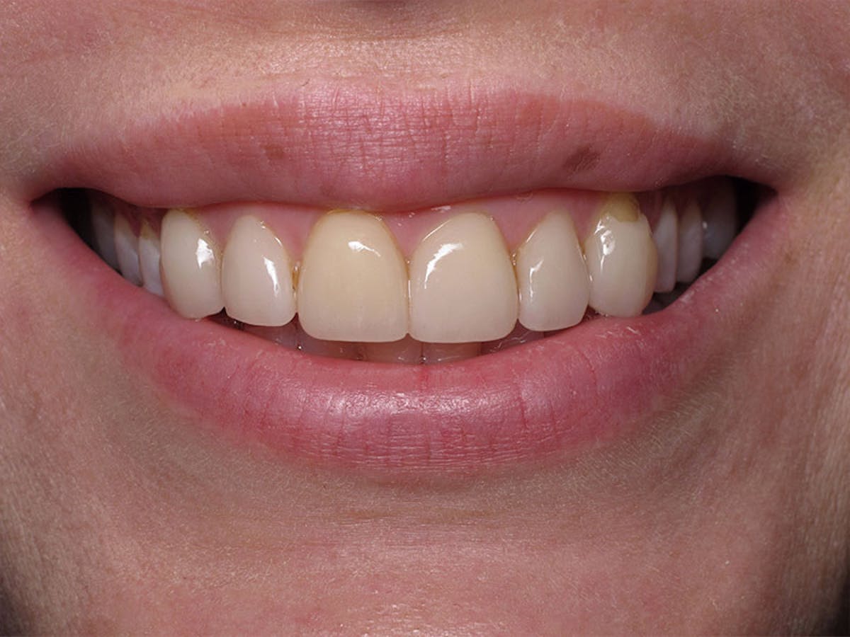 Smile Makeover Closeups Before & After Gallery - Patient 192281087 - Image 1