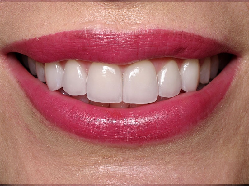 Smile Makeover Closeups Before & After Gallery - Patient 192281087 - Image 2