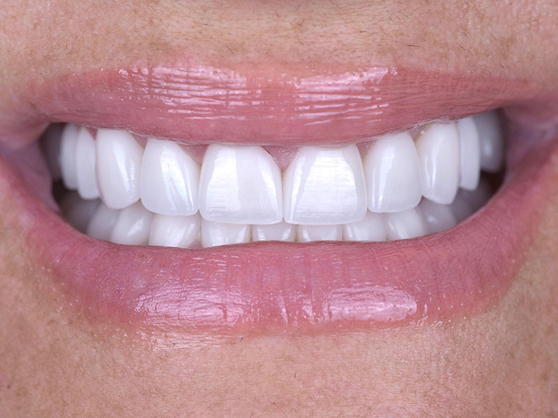 Smile Makeover Closeups Before & After Gallery - Patient 192281091 - Image 2