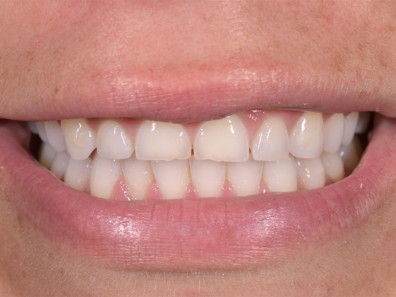 Smile Makeover Closeups Before & After Gallery - Patient 192463059 - Image 1
