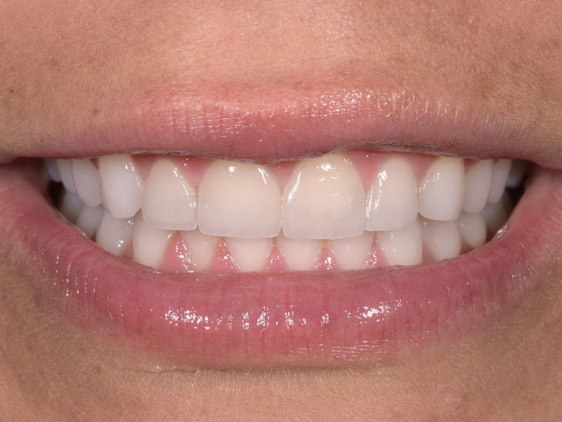 Smile Makeover Closeups Before & After Gallery - Patient 192463059 - Image 2