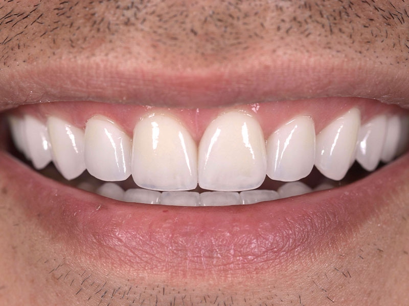 Smile Makeover Closeups Before & After Gallery - Patient 192463057 - Image 2