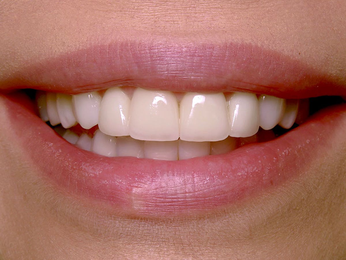Smile Makeover Closeups Before & After Gallery - Patient 192463056 - Image 1