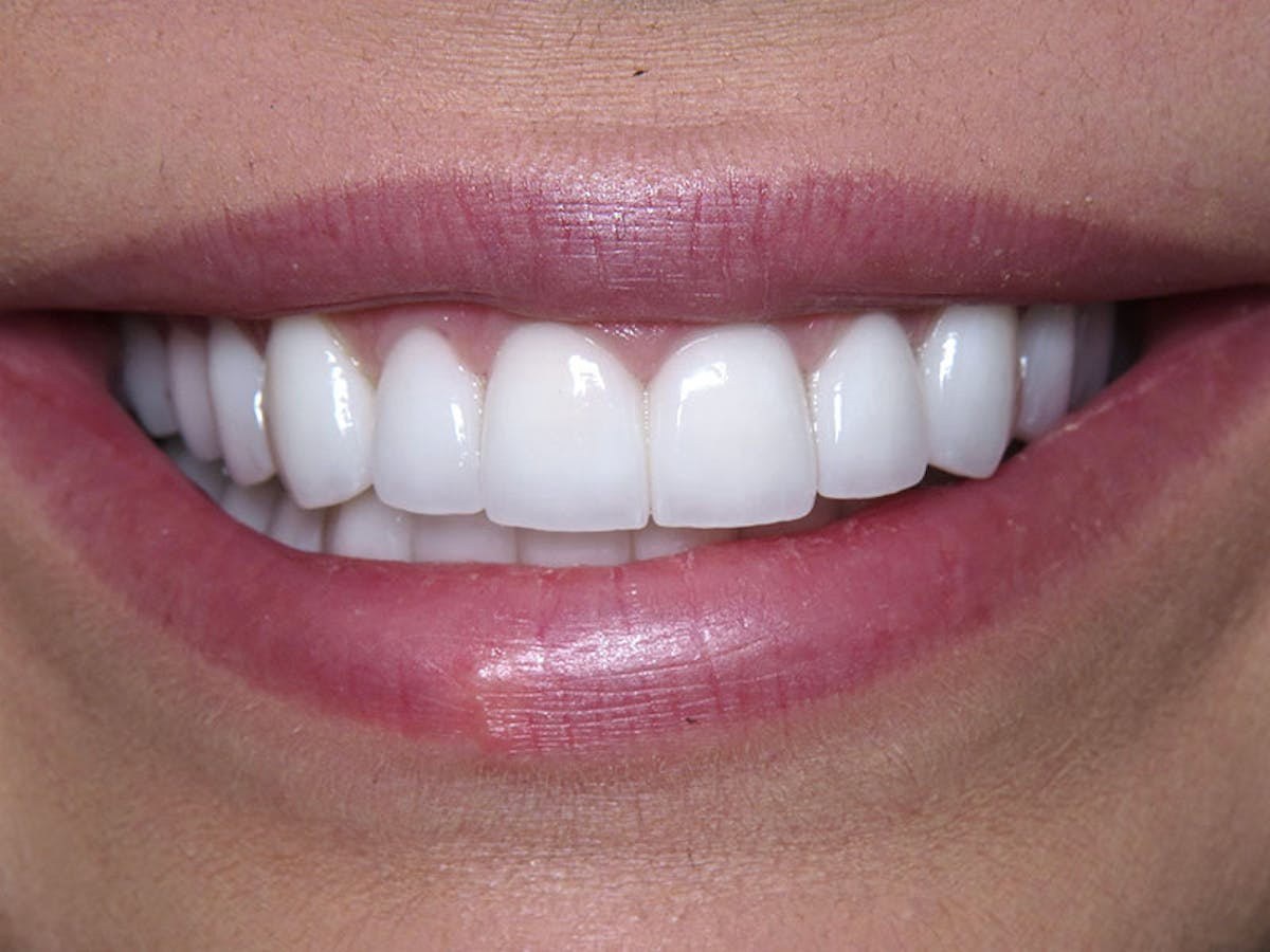 Smile Makeover Closeups Before & After Gallery - Patient 192463056 - Image 2