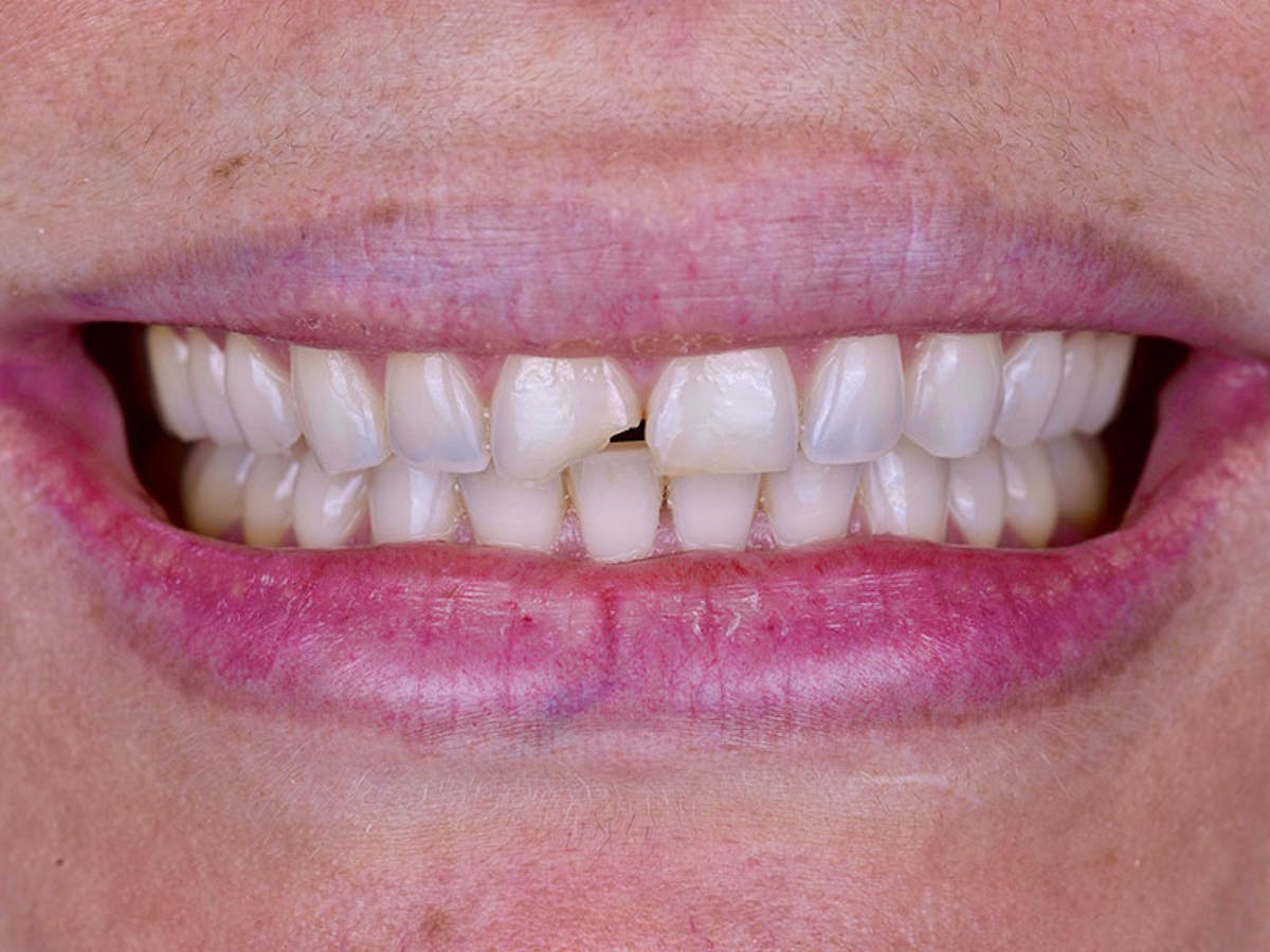 Smile Makeover Closeups Before & After Gallery - Patient 192463061 - Image 1