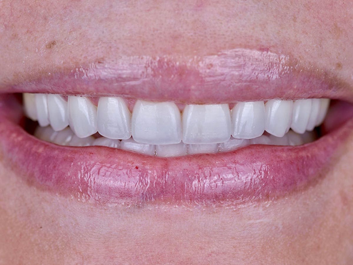 Smile Makeover Closeups Before & After Gallery - Patient 192463061 - Image 2