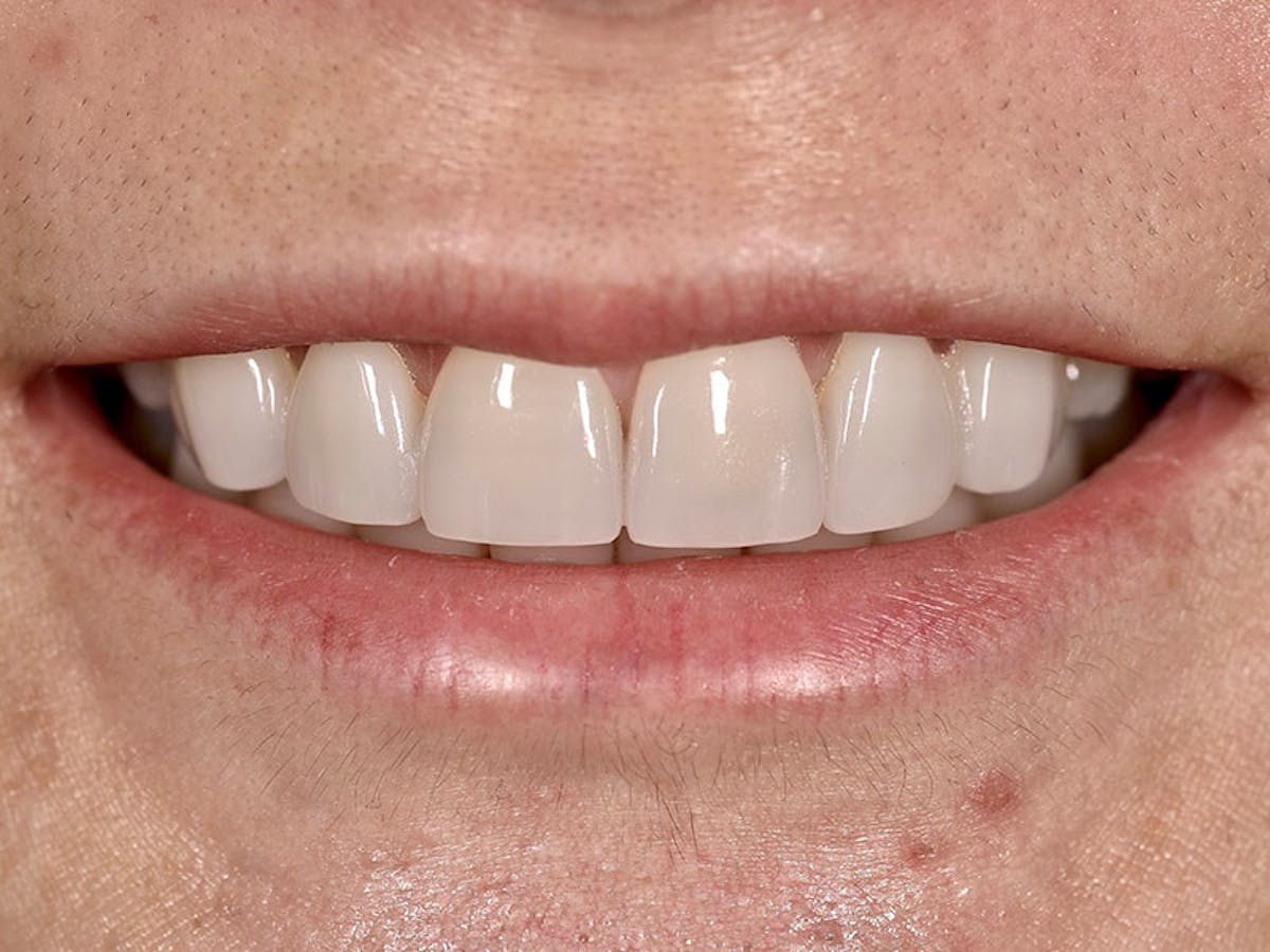 Smile Makeover Closeups Before & After Gallery - Patient 192463058 - Image 1