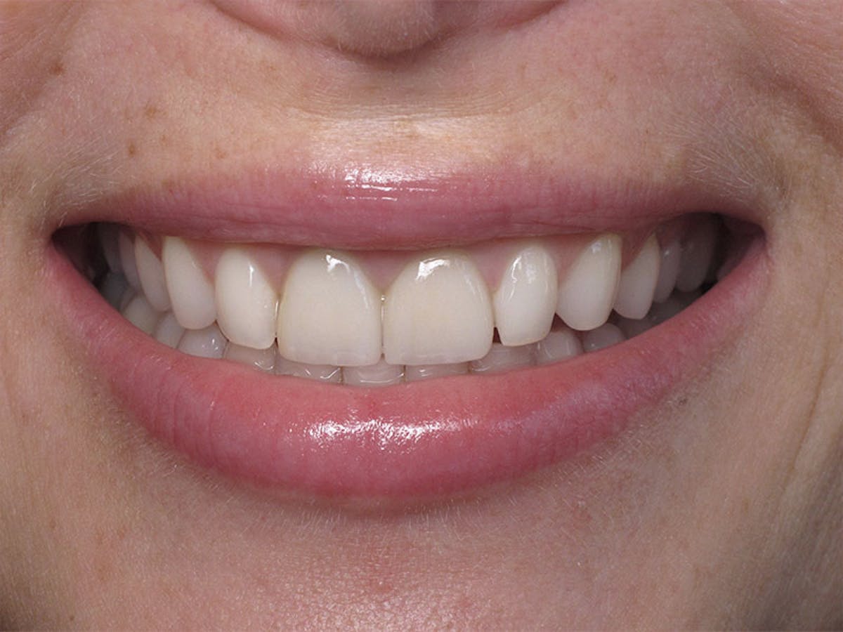 Smile Makeover Closeups Before & After Gallery - Patient 192463055 - Image 1