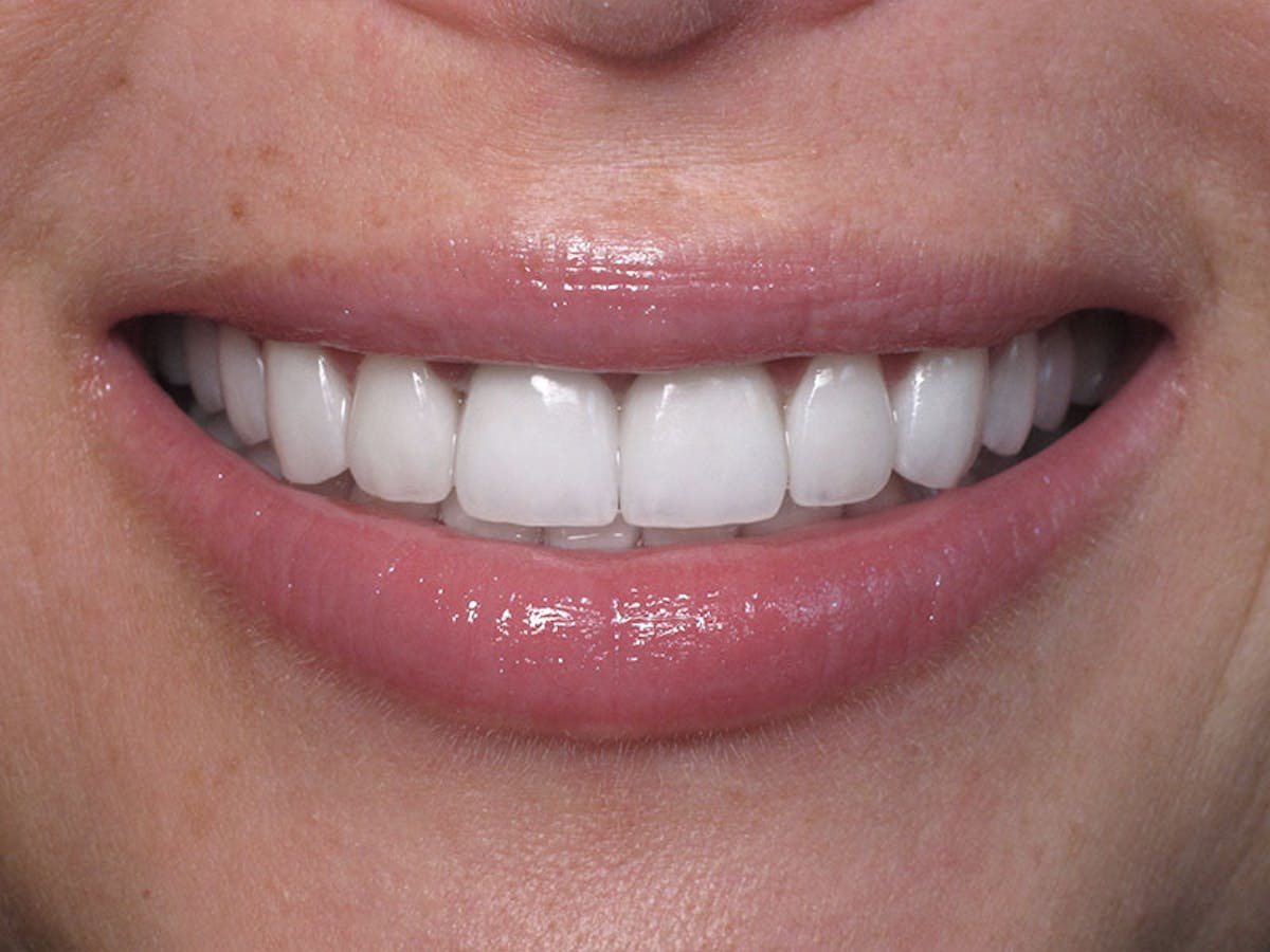 Smile Makeover Closeups Before & After Gallery - Patient 192463055 - Image 2