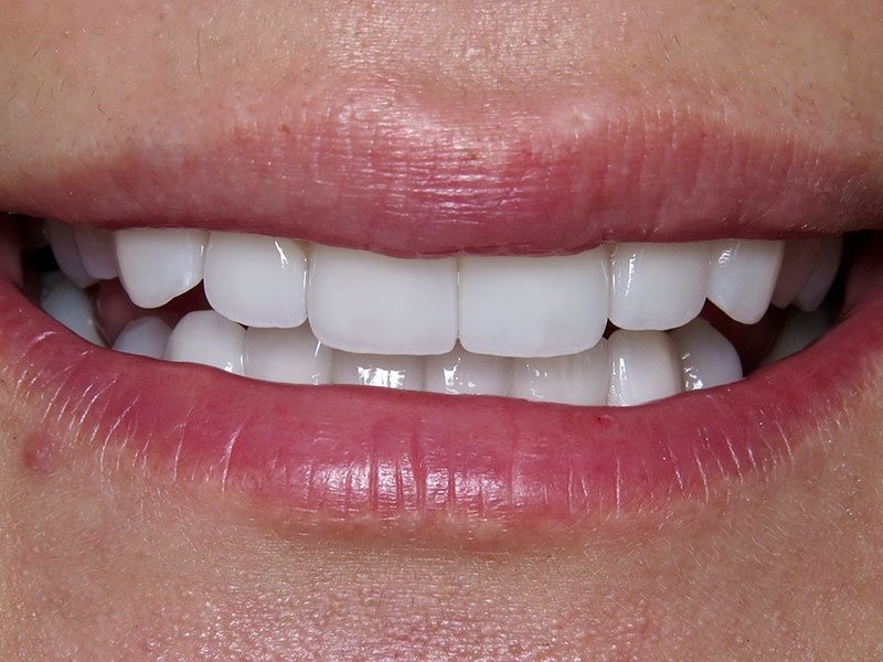 Smile Makeover Closeups Before & After Gallery - Patient 192463060 - Image 2