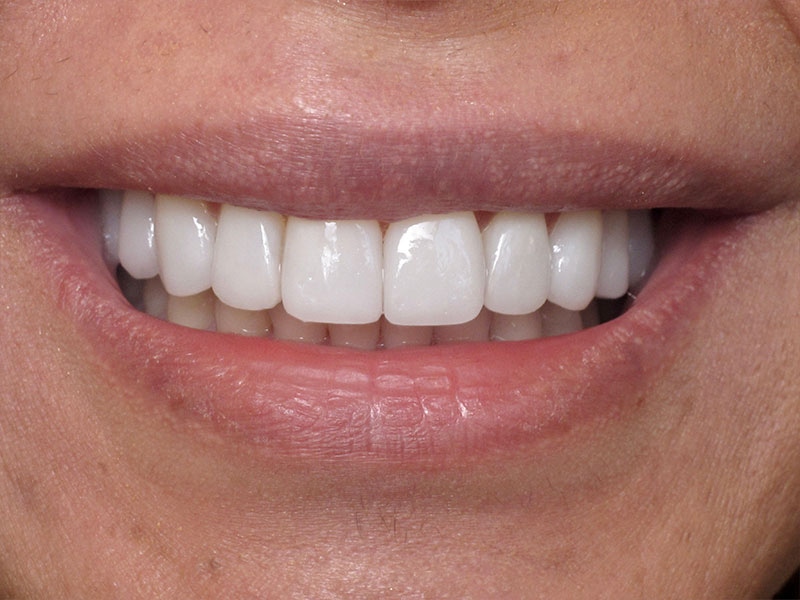 Smile Makeover Closeups Before & After Gallery - Patient 192463054 - Image 1