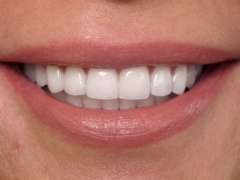 Smile Makeover Closeups Before & After Gallery - Patient 192463054 - Image 2