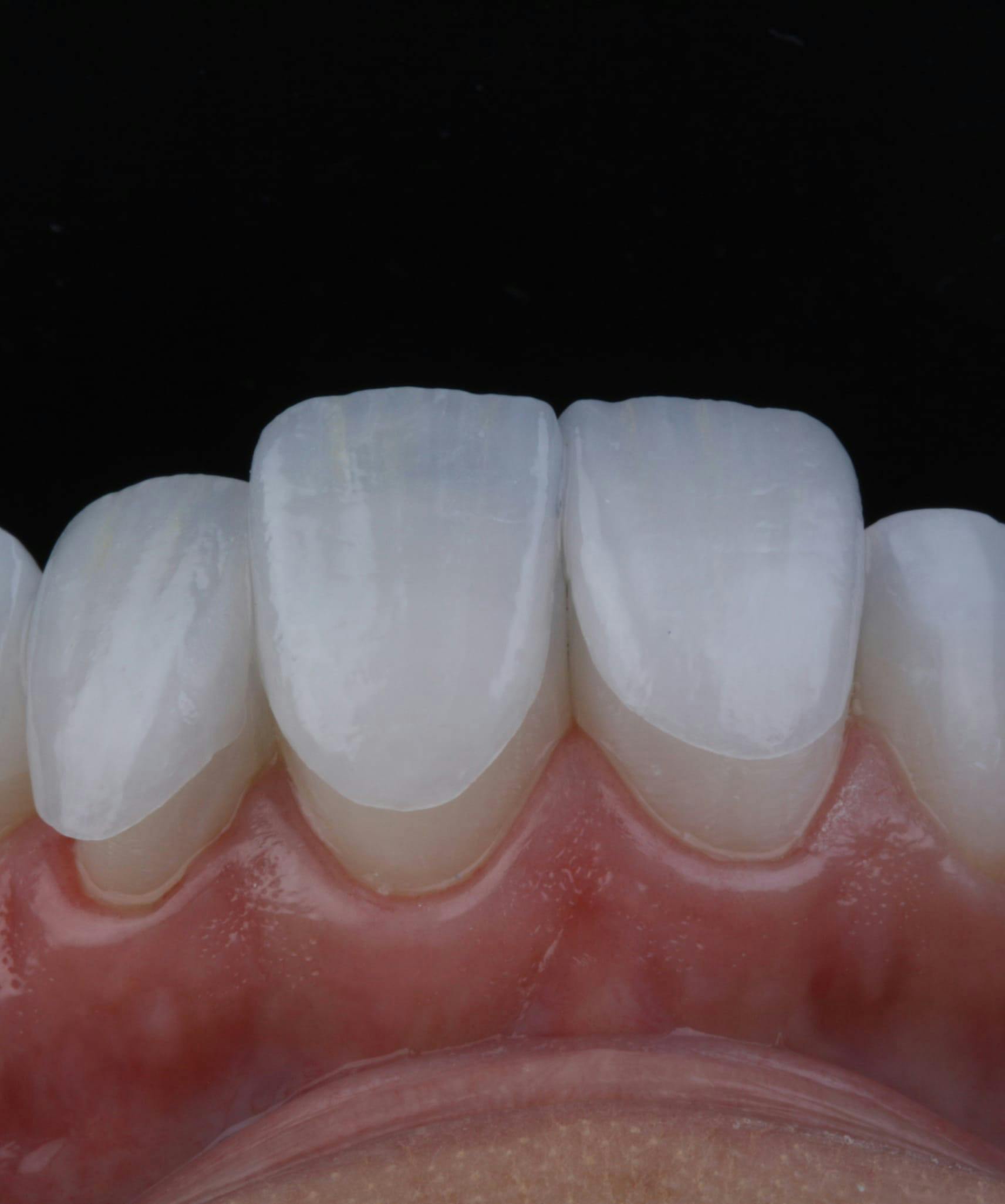 Facettes Dentaires Antérieures #22 23 24 – Porcelaine Résine Teintes A1 A2 A3, 96 Pièces