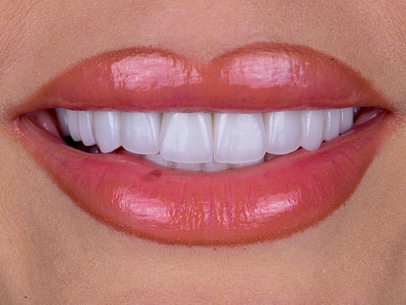 Smile Makeover Closeups Before & After Gallery - Patient 258707 - Image 2