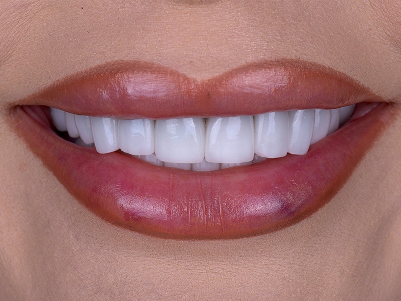 Smile Makeover Closeups Before & After Gallery - Patient 258707 - Image 1