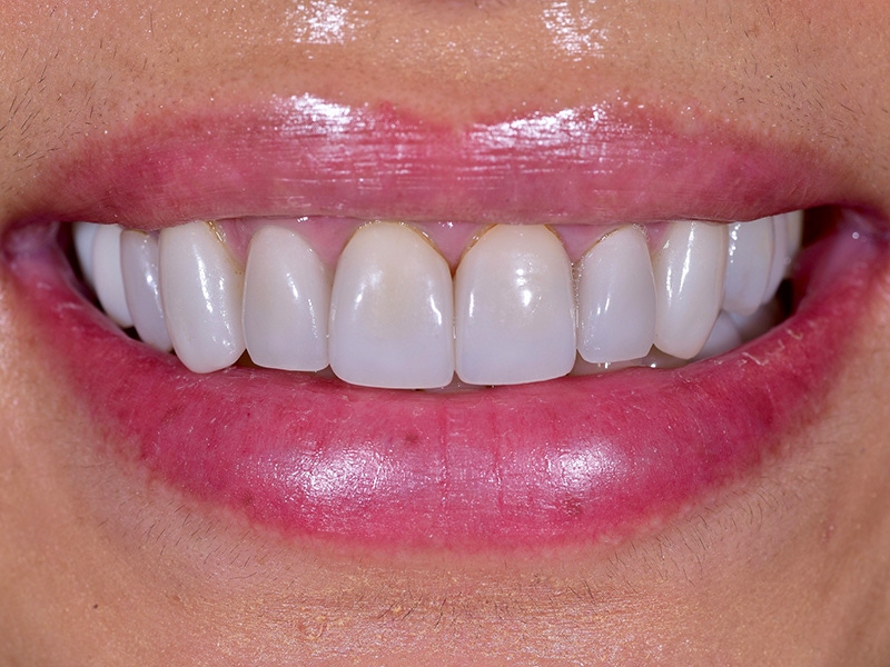 Smile Makeover Closeups Before & After Gallery - Patient 684071 - Image 1
