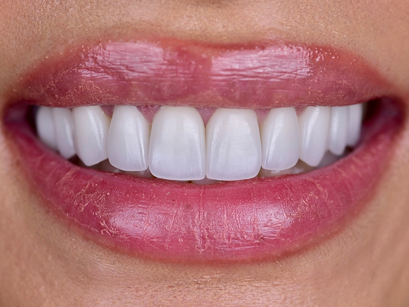 Smile Makeover Closeups Before & After Gallery - Patient 684071 - Image 2