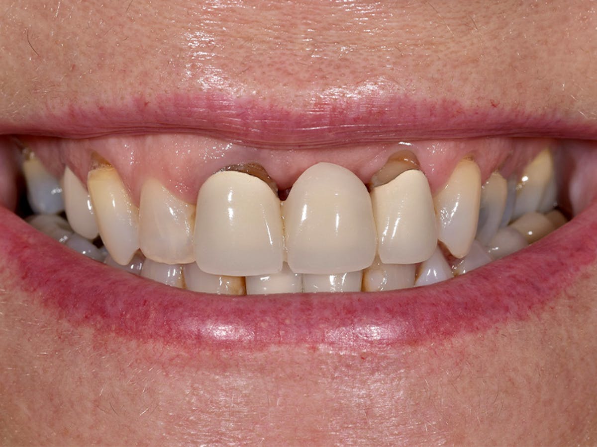 Smile Makeover Closeups Before & After Gallery - Patient 969787 - Image 1