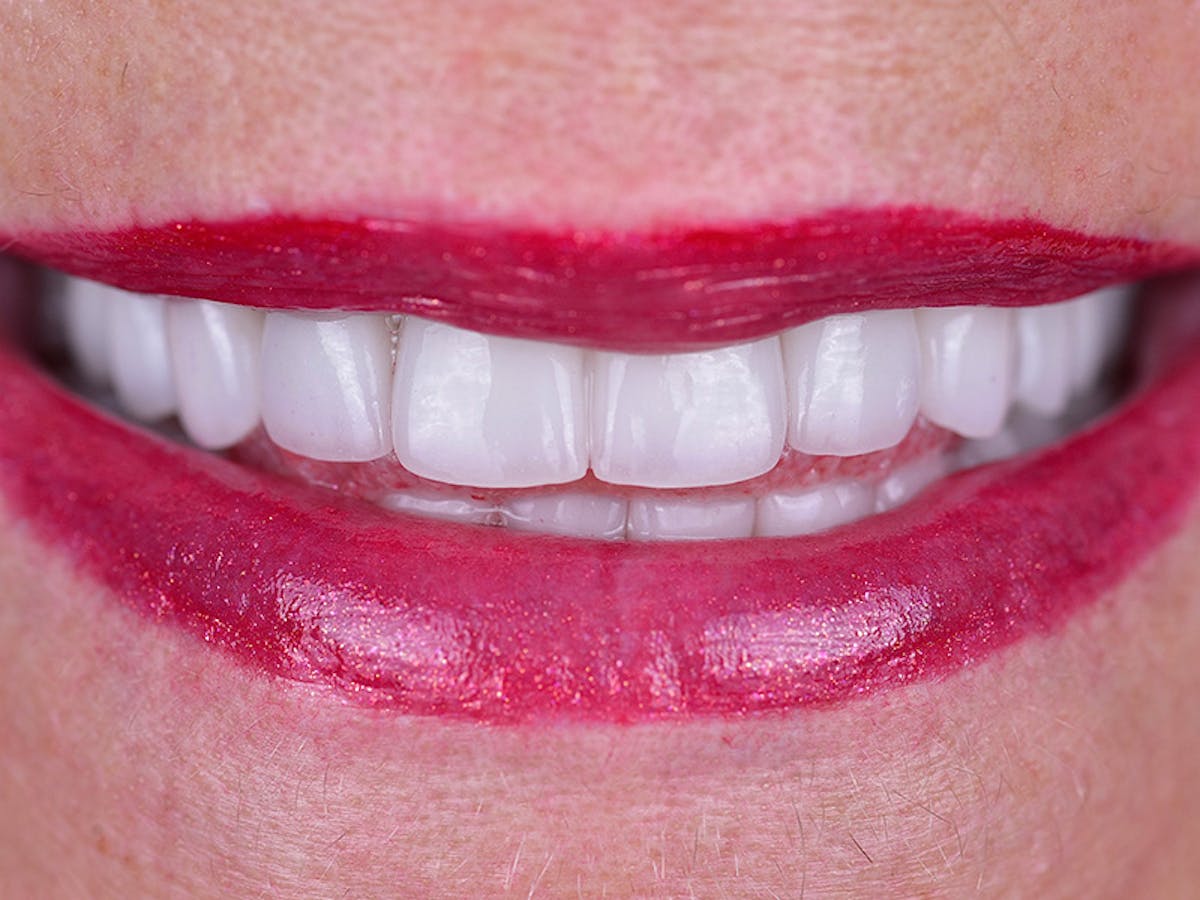 Smile Makeover Closeups Before & After Gallery - Patient 969787 - Image 2