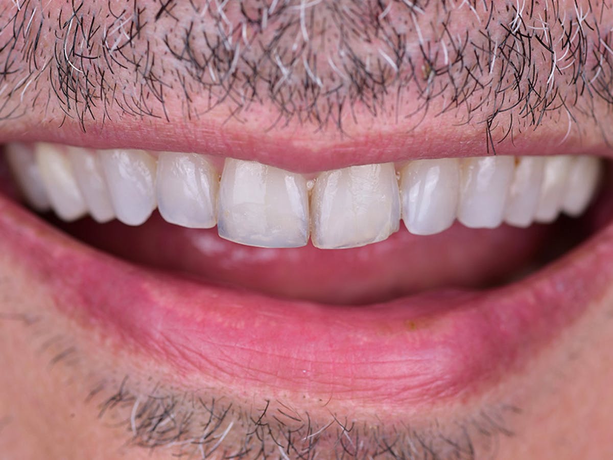 Smile Makeover Closeups Before & After Gallery - Patient 265762 - Image 1